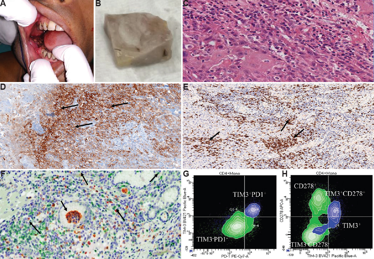 Immunohistochemistry and flowcytometry images of oral cancer. (A) Irregular growth in lower Gingivobuccal region. (B) Excised tumour from oral cancer patient. (C) Haematoxylin and eosin stain (×40) showing nucleoli islands, each with moderate to abundant cytoplasm, and hyperchromatic nuclei. (D) Scattered brown DAB staining indicates CD3+ lymphocytes (×20). (E) Brown PDL1+ (×20) expressing cells with marginal infiltration. (F) Bright field view (×40) composite CD3, CD15, arginase, granzyme, CD68, nuclei in green, yellow, orange, magenta, red, blue, respectively. (G) TIM3+ PD1+ co-expression in blue monocytes and TIM3-PD1- expressed by green lymphocytes. (H) CD278+ in green lymphocytes & TIM3+CD278+ coexpression in the monocytic population.